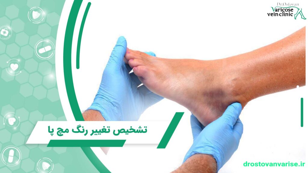 detection ankle discoloration