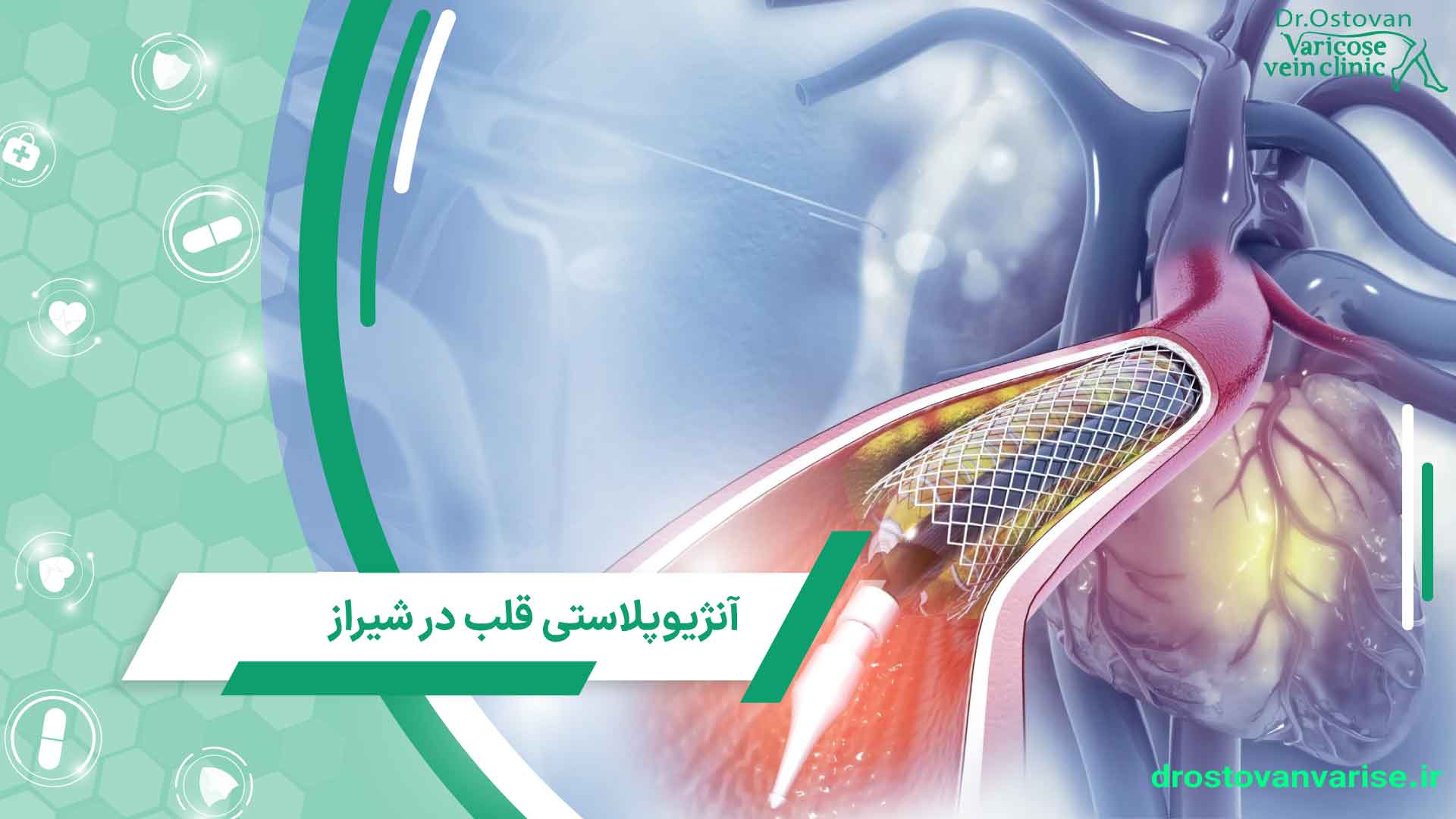 coronary angioplasty