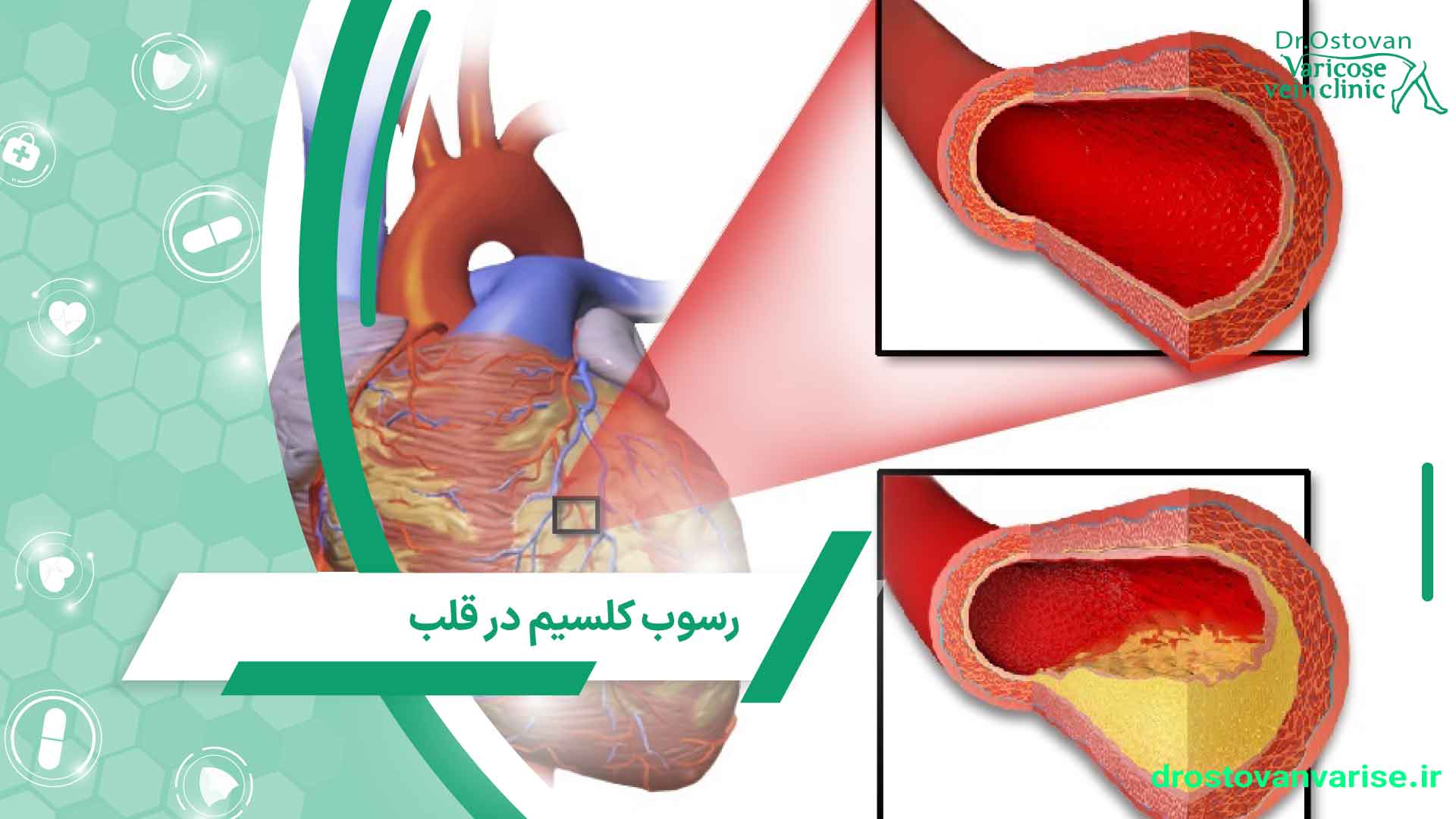علت رسوب کلسیم چیست؟
