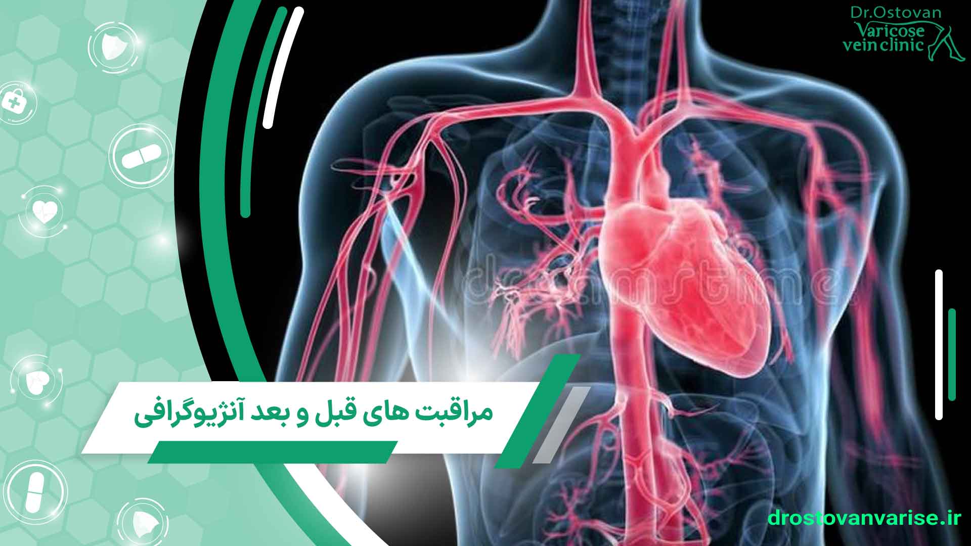 چگونه برای آنژیوگرافی قلب آماده شویم؟